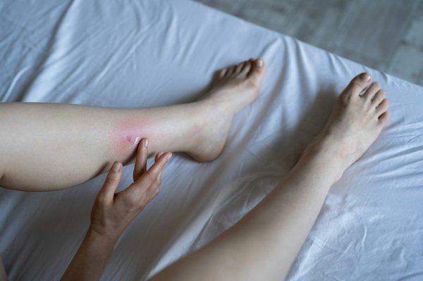 Housses anti-punaises de lit : votre allié contre les nuisibles